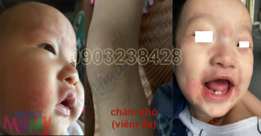 Hình ảnh Bé bị chàm sữa tại Nam Định